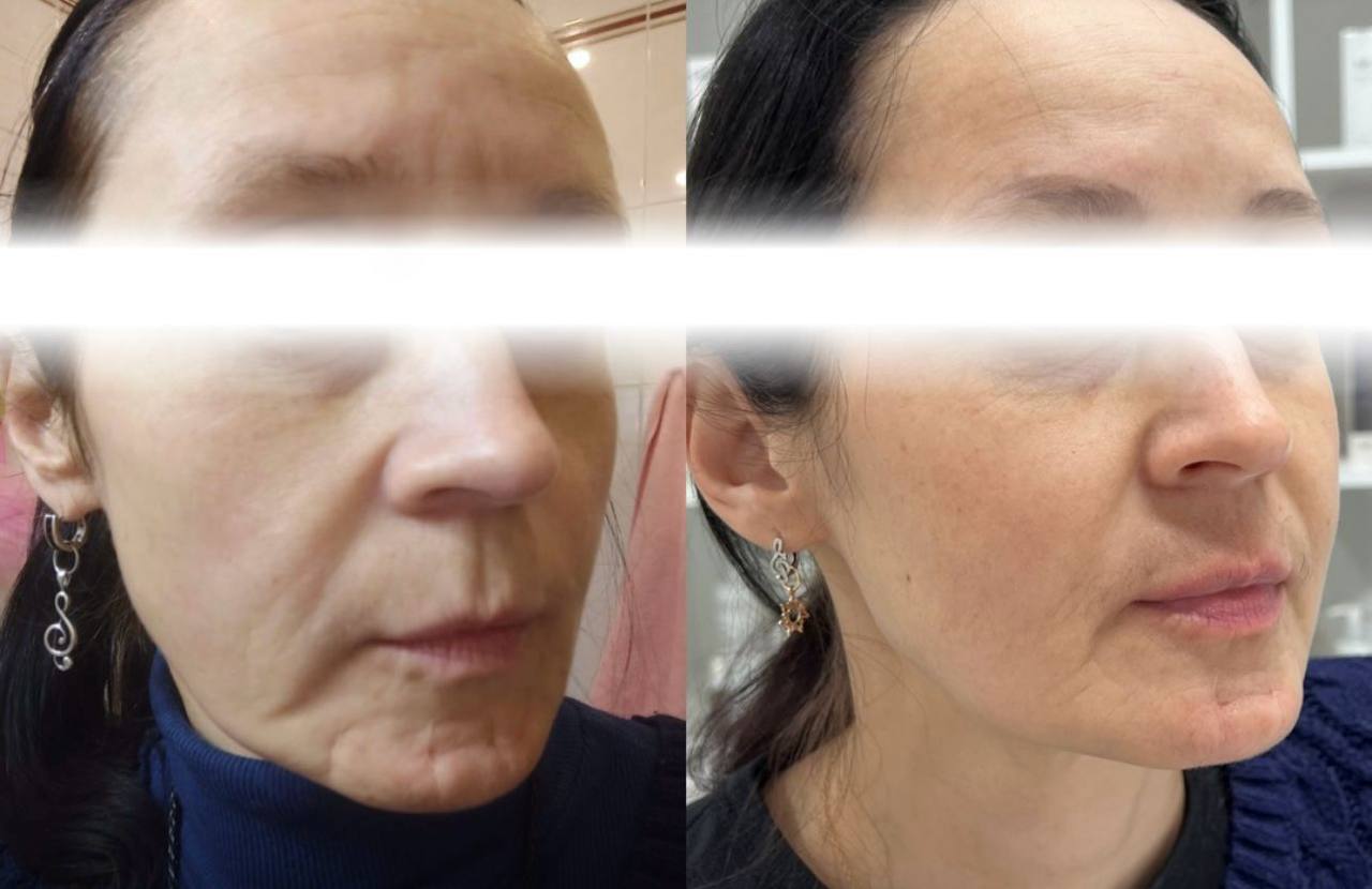 Реальный anti-age кейс до и после по овалу лица